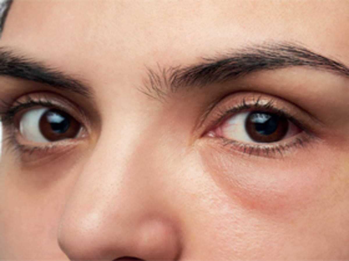 طرق منزلية للتخلص من انتفاخ أسفل العينين