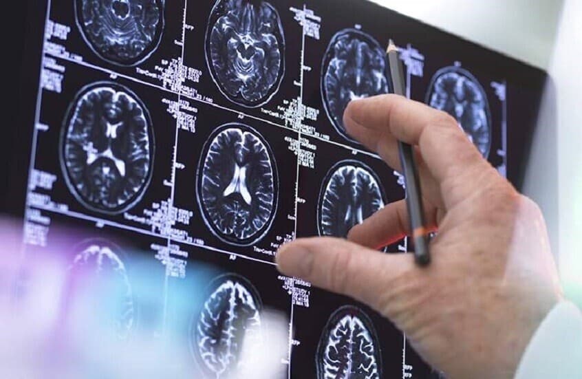 اكتشاف روسي يسرع ابتكار علاجات فعالة لأكثر أنواع أورام الدماغ عدوانية