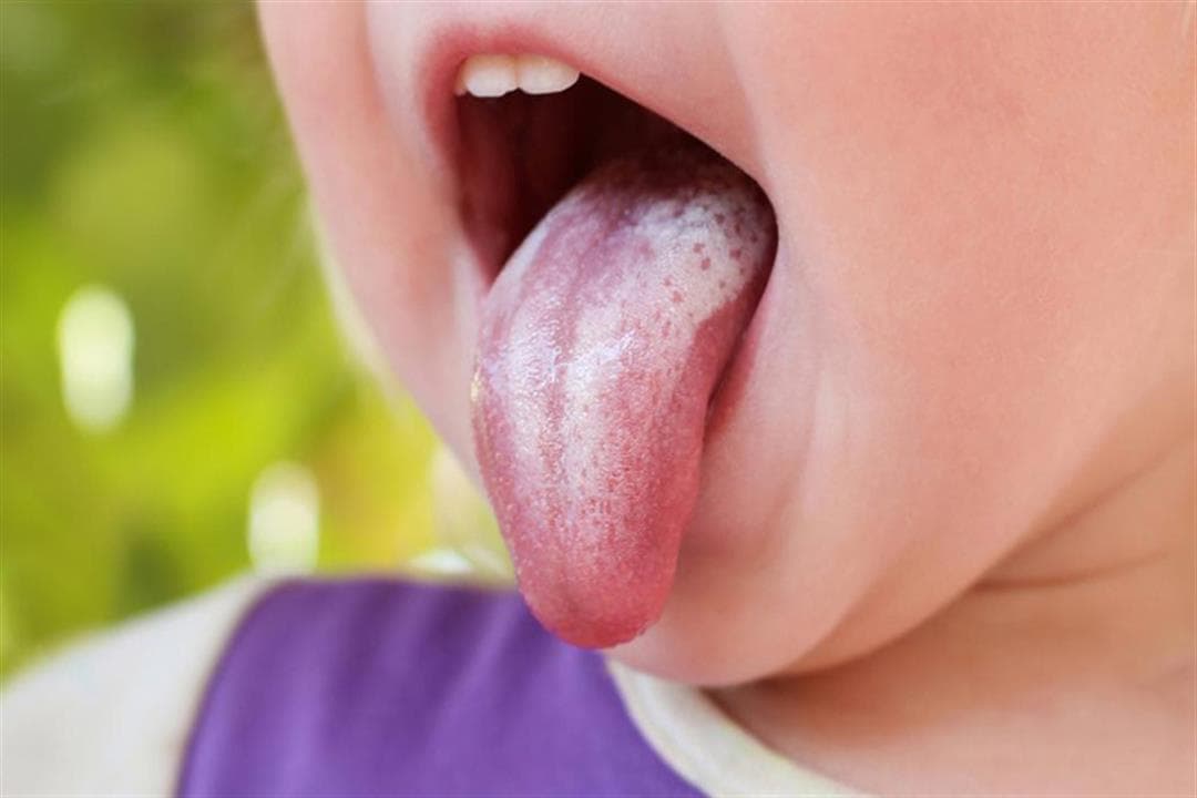 إلى ماذا يشير ابيضاض اللسان؟