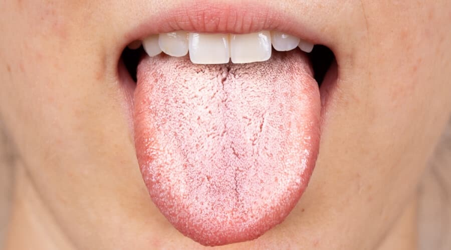 ما أسباب حرقان اللسان؟