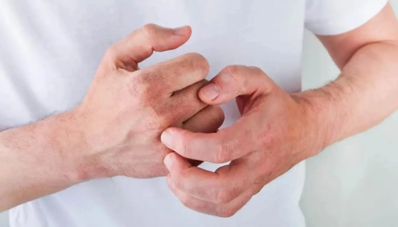 تكرار الإصابة بالحمى يرفع خطر أكزيما الأطفال